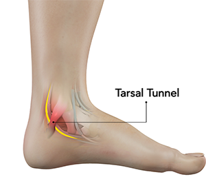 Tarsal Tunnel Syndrome New York Ny Tarsal Tunnel Release New York Foot Ankle Pain