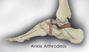 fused ankle bones
