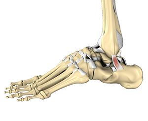 Foot Sprain Treatment - Foot and Ankle Surgeons of New York