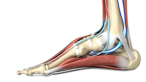 Posterior Tibial Tendon Dysfunction w/ Flat Foot Reconstruction Options