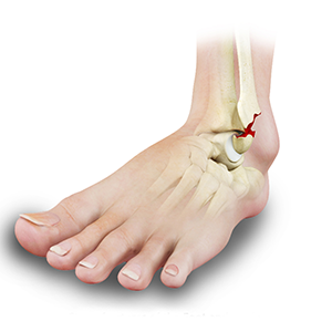 https://www.sportsmedicinenewyork.com/3d-images/stress-fractures-foot-and-ankle.png