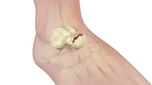 Stress Fracture Of The Talus - Ankle - Conditions - Musculoskeletal - What  We Treat 